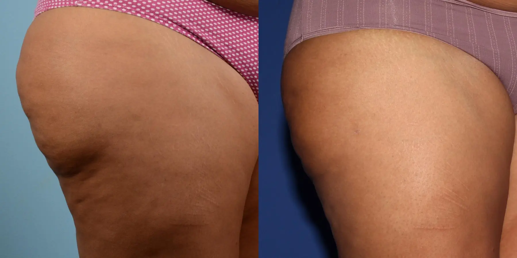 Cellulite Reduction: Patient 2 - Before and After 5