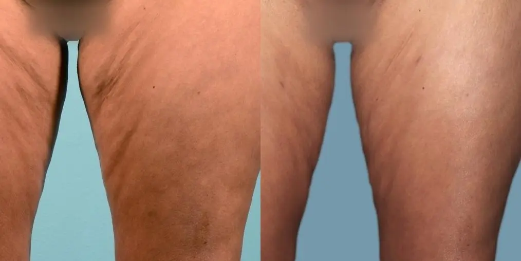 Cellulite Reduction: Patient 4 - Before and After 1