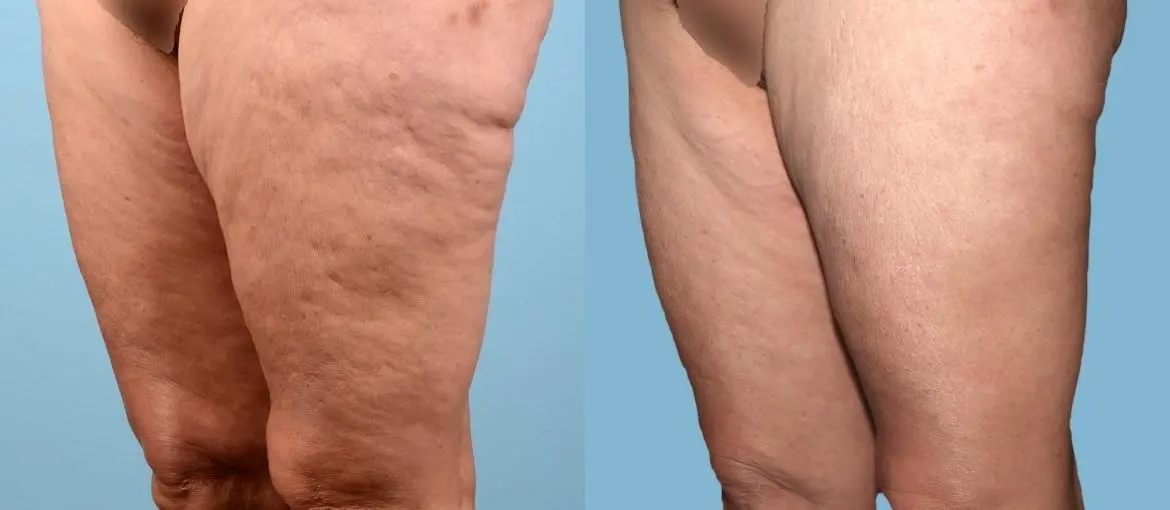 Cellulite Reduction: Patient 1 - Before and After 2