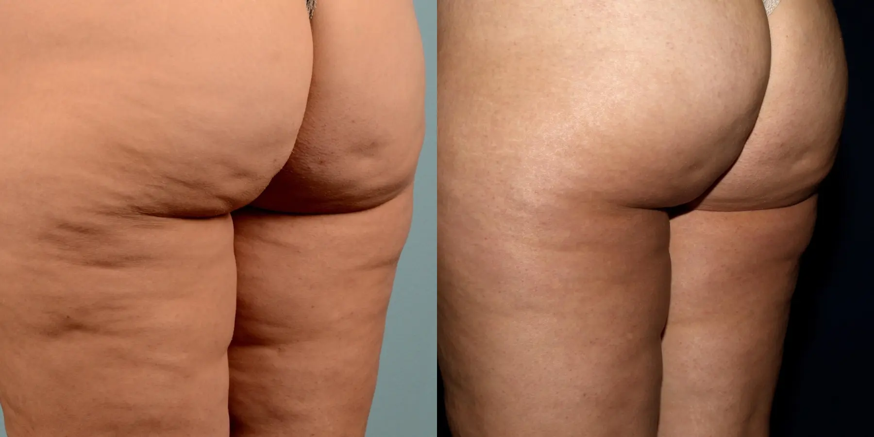 Cellulite Reduction: Patient 3 - Before and After 3