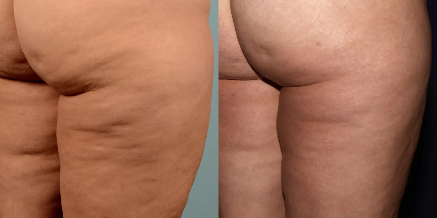 Cellulite Reduction: Patient 3 - Before and After 2