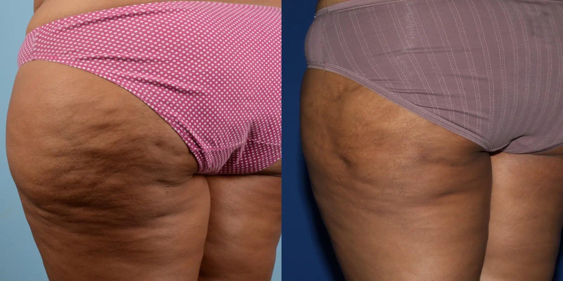 Cellulite Reduction: Patient 2 - Before and After 3