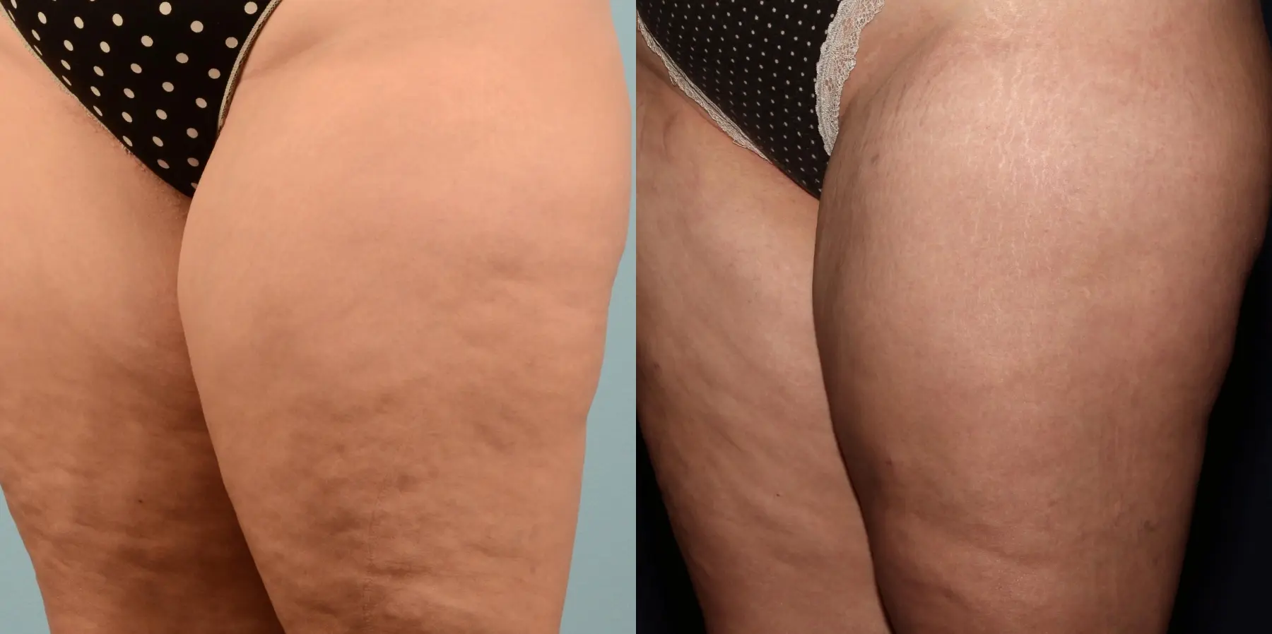 Cellulite Reduction: Patient 3 - Before and After 5