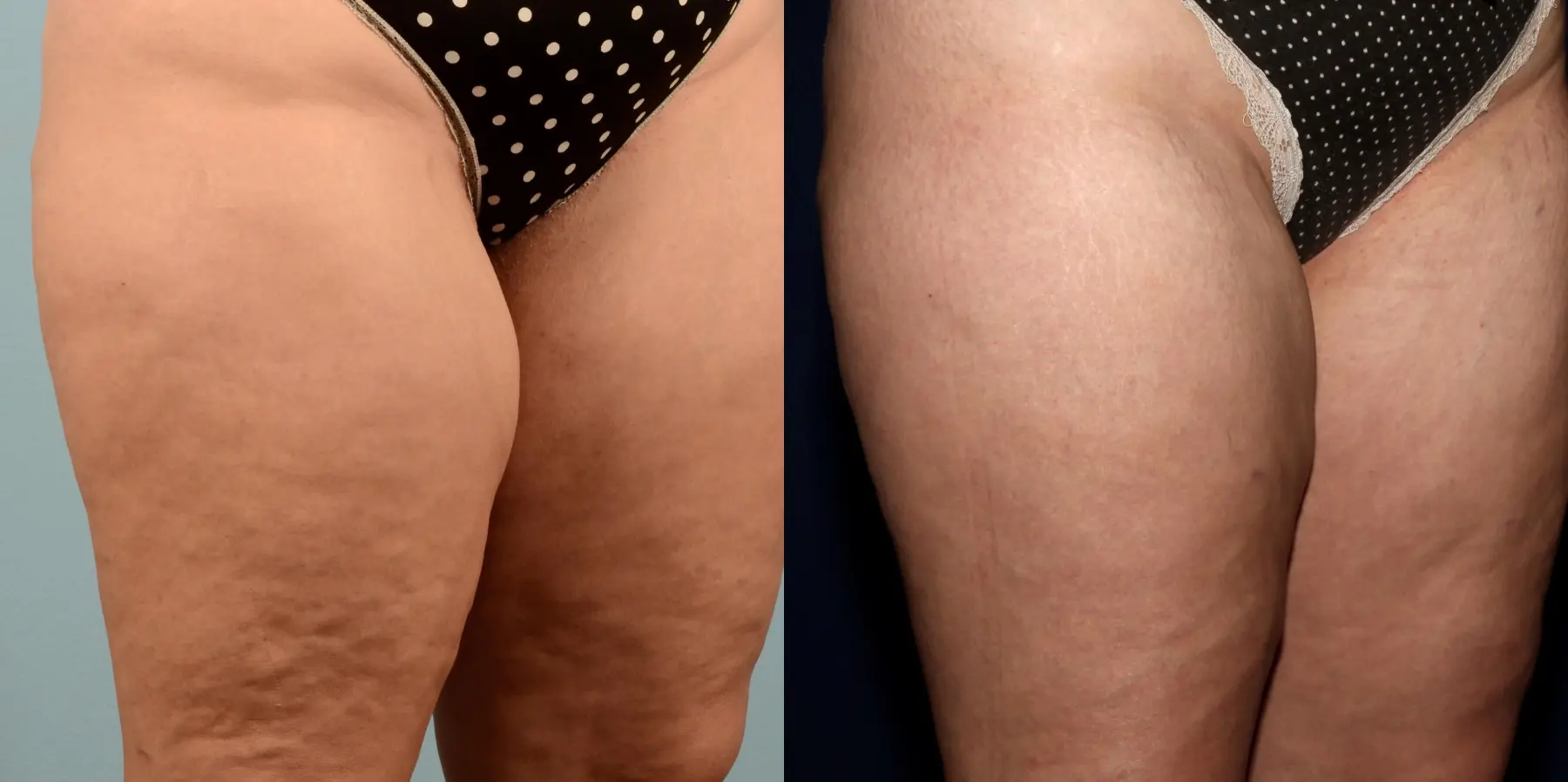 Cellulite Reduction: Patient 3 - Before and After 6