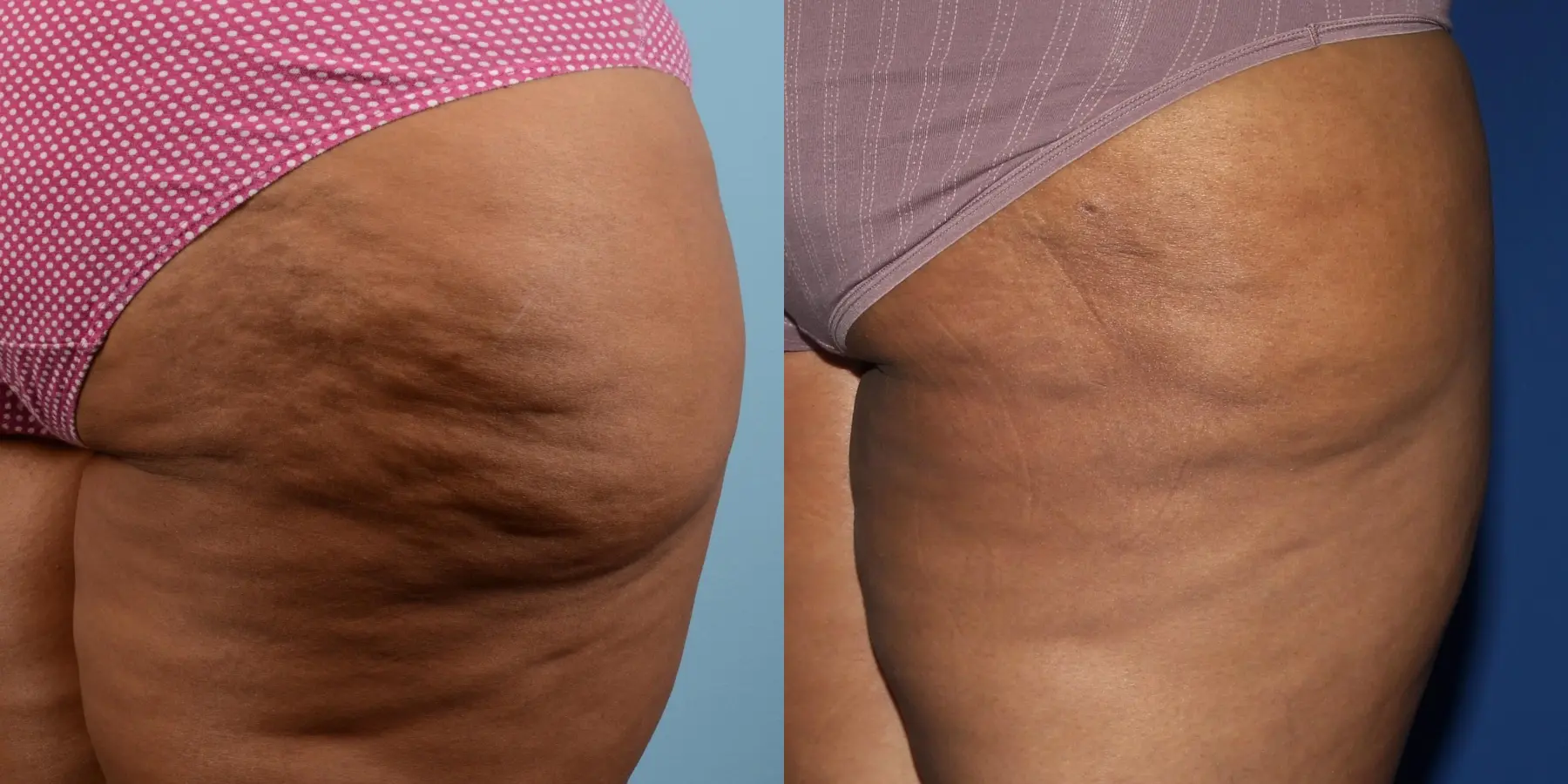 Cellulite Reduction: Patient 2 - Before and After 4