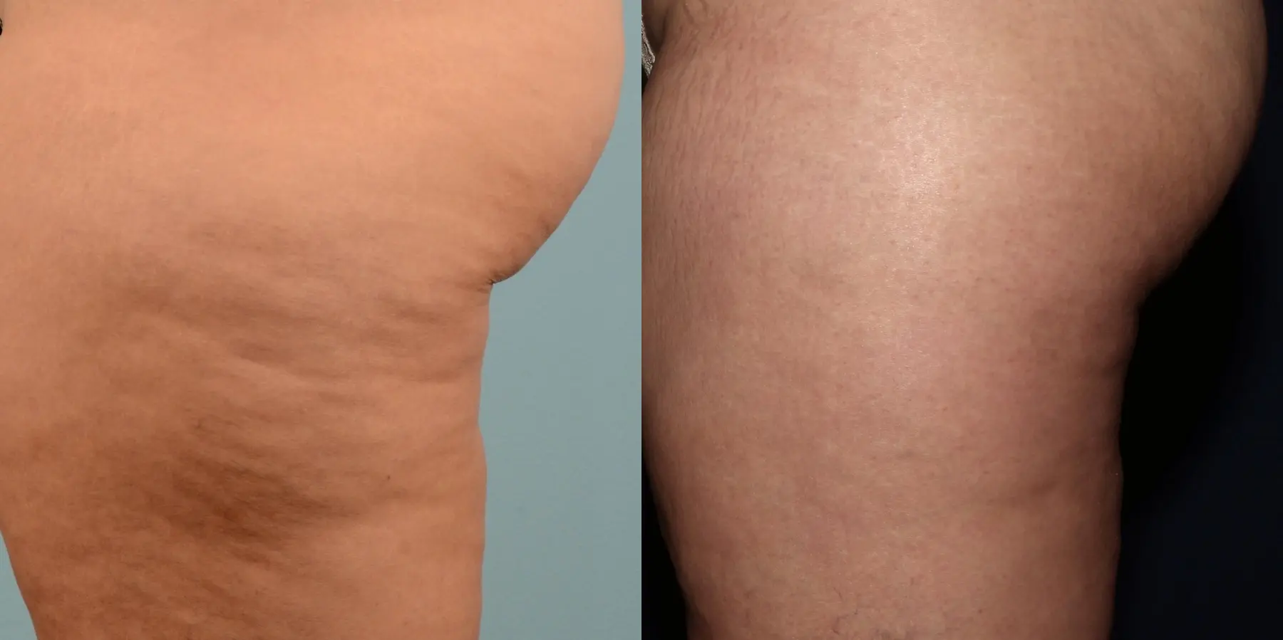 Cellulite Reduction: Patient 3 - Before and After 4