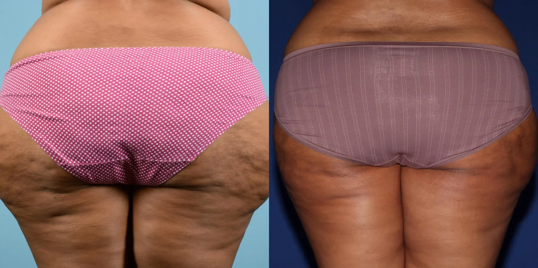 Cellulite Reduction: Patient 2 - Before and After  