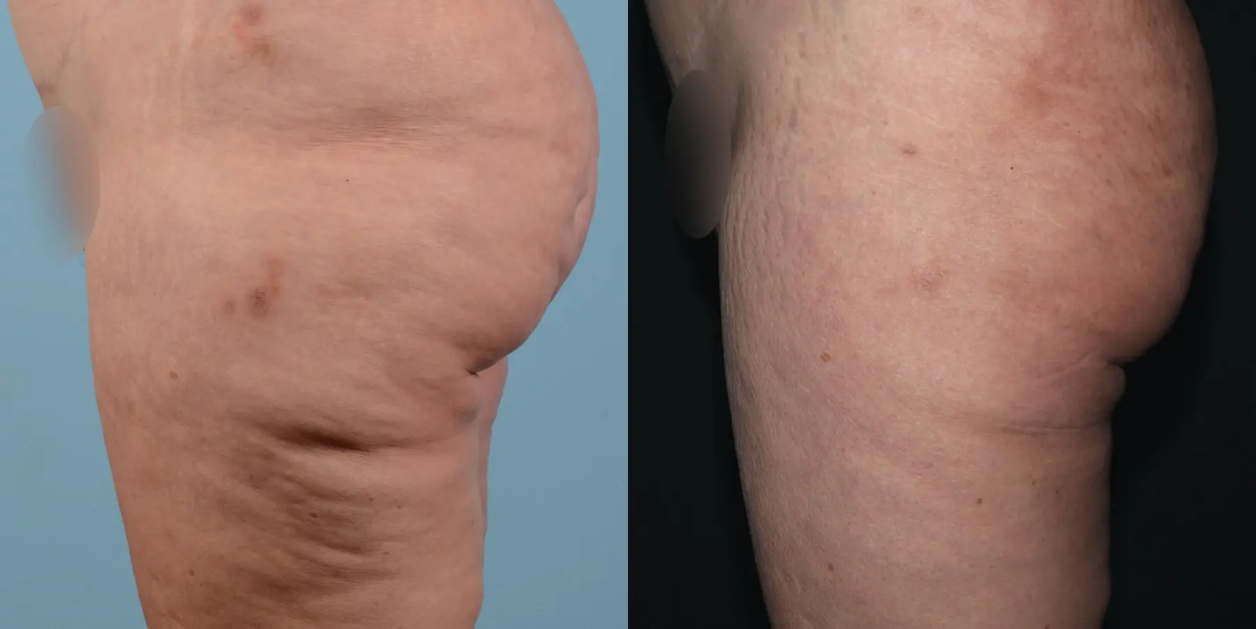 Cellulite Reduction: Patient 1 - Before and After 3