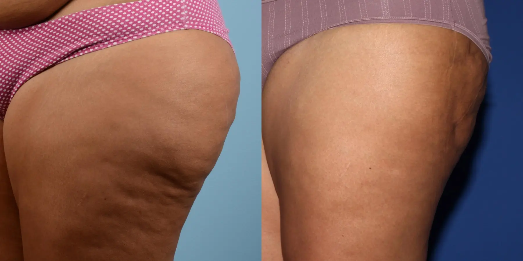 Cellulite Reduction: Patient 2 - Before and After 6