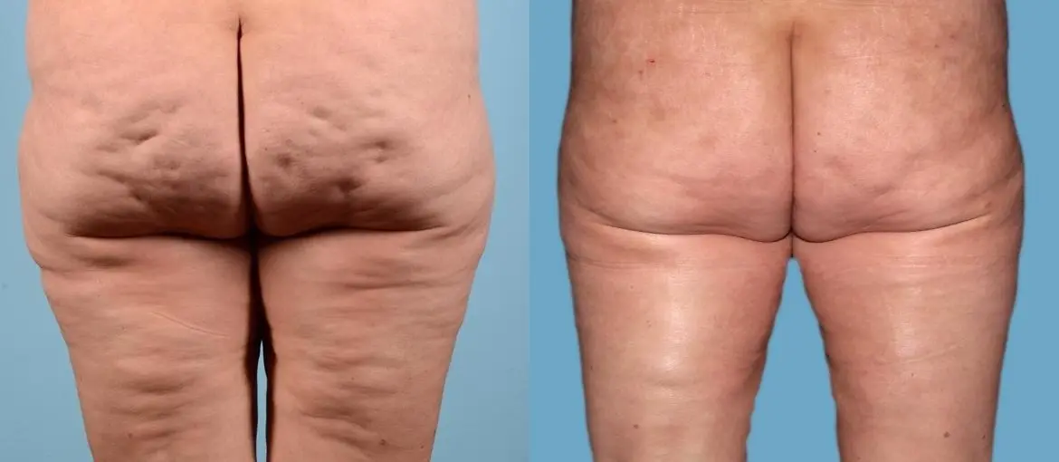 Cellulite Reduction: Patient 1 - Before and After 5