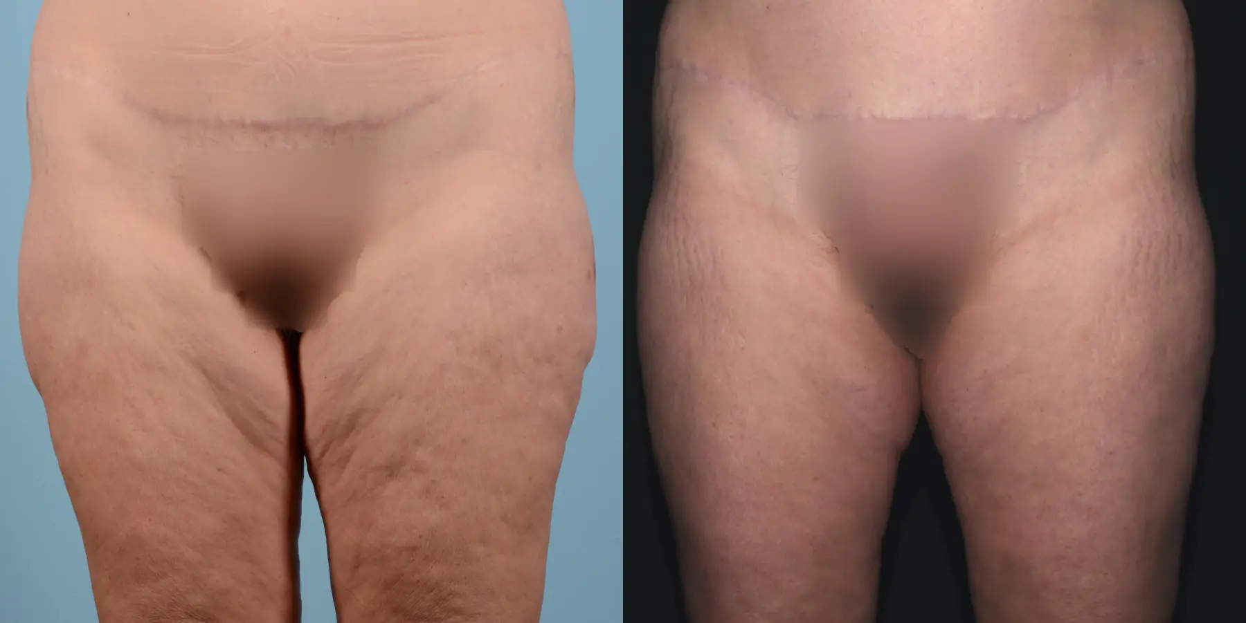 Cellulite Reduction: Patient 1 - Before and After 6