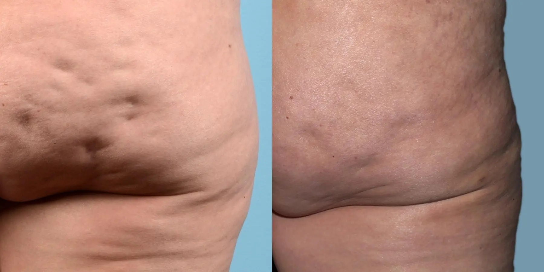 Cellulite Reduction: Patient 1 - Before and After 1