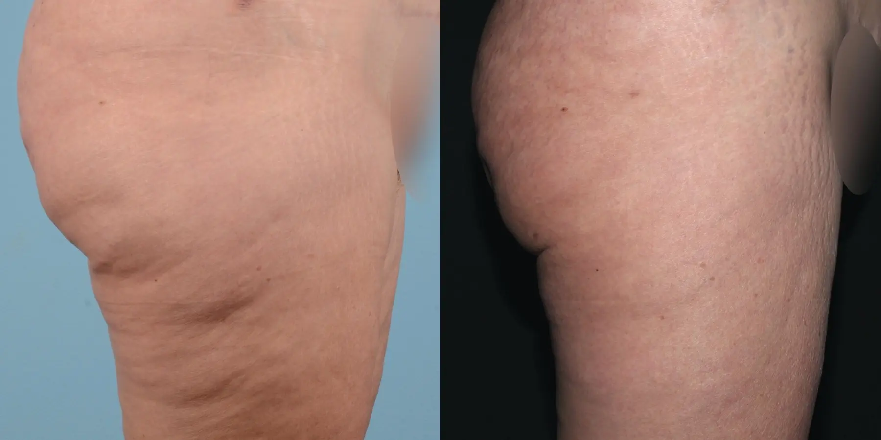 Cellulite Reduction: Patient 1 - Before and After 4