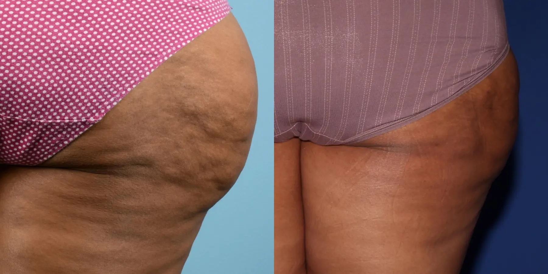 Cellulite Reduction: Patient 2 - Before and After 2