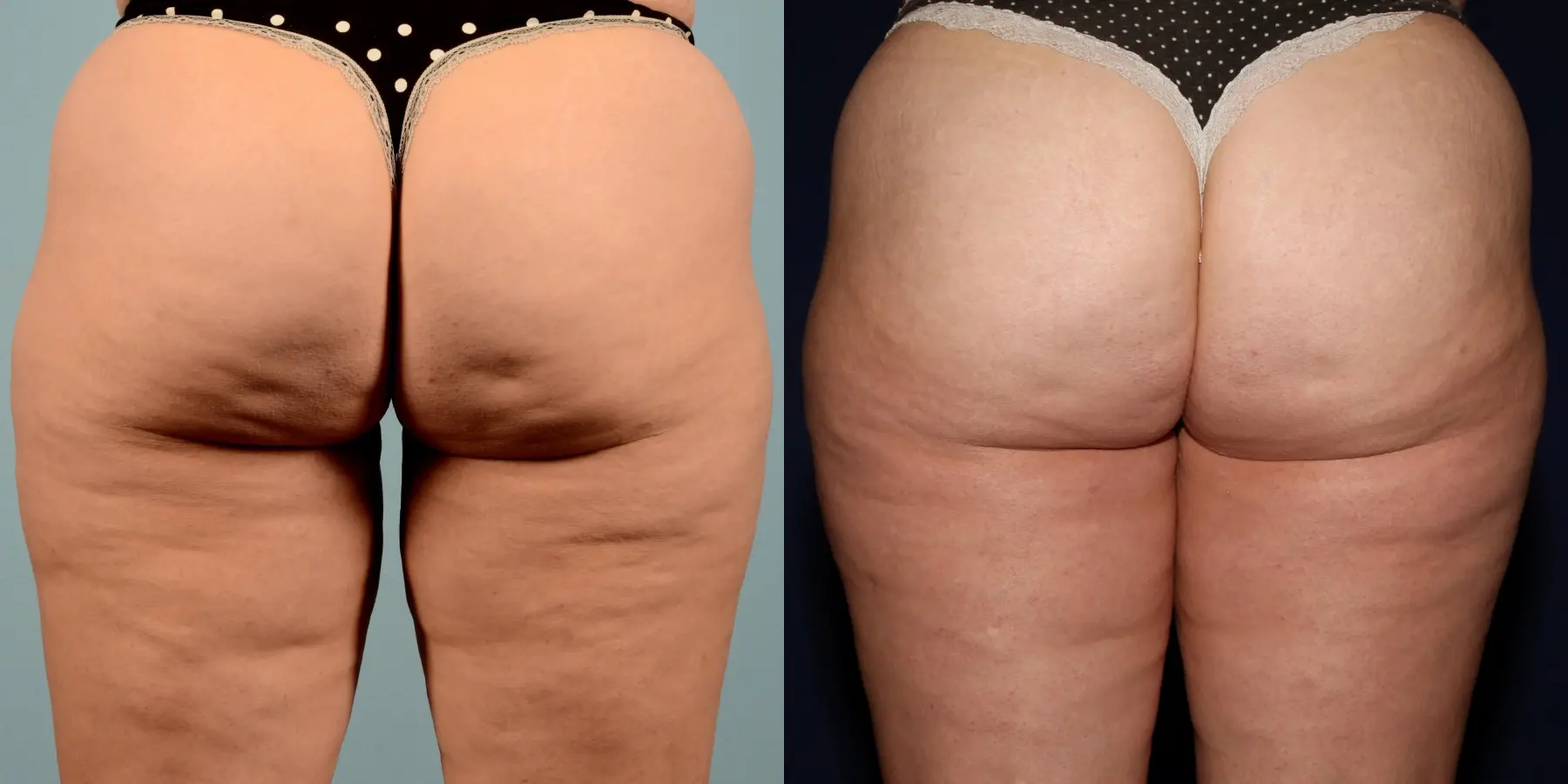 Cellulite Reduction: Patient 3 - Before and After 1