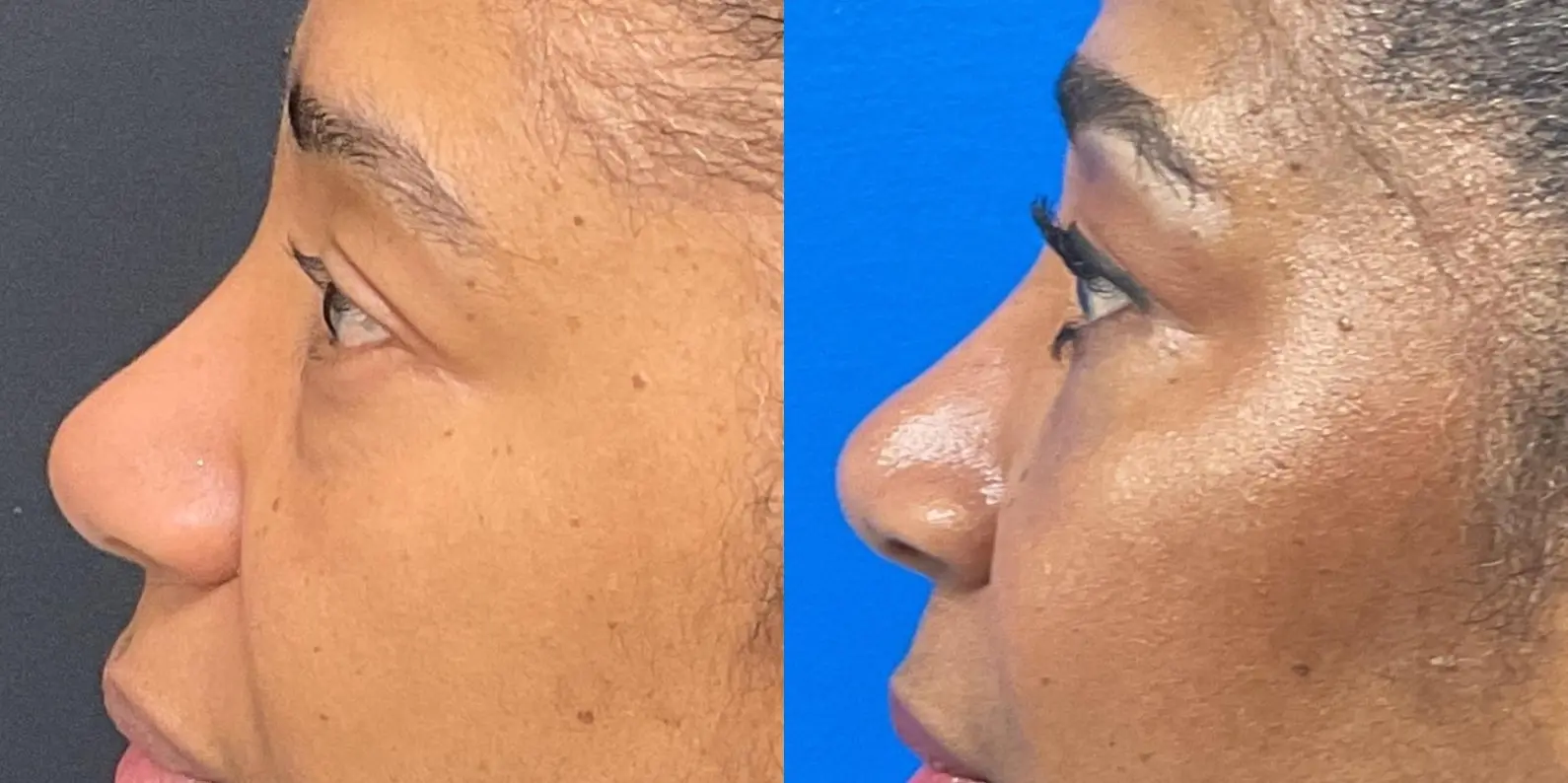 Eyelid Surgery: Patient 1 - Before and After 5