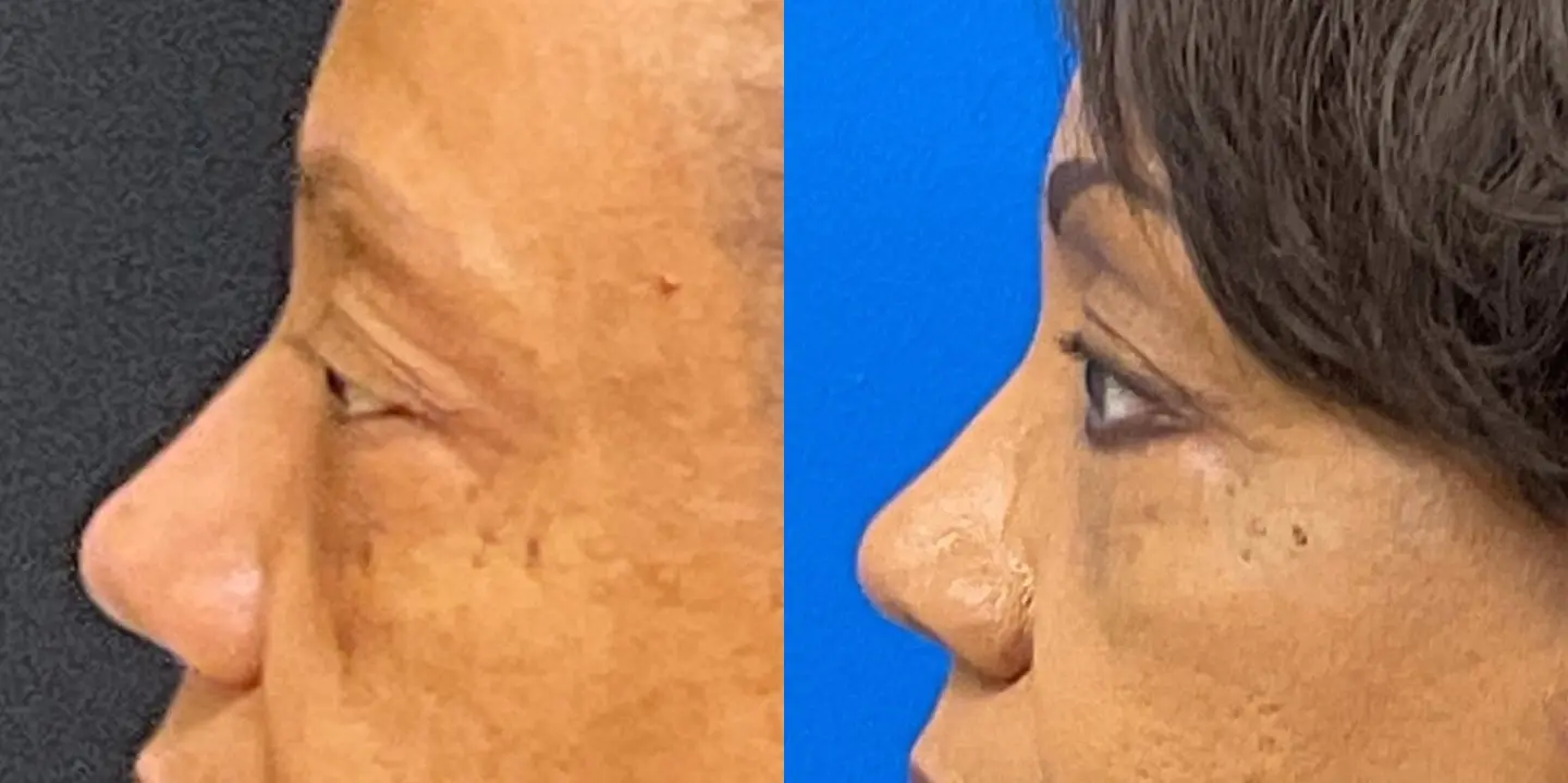 Eyelid Surgery: Patient 3 - Before and After 4