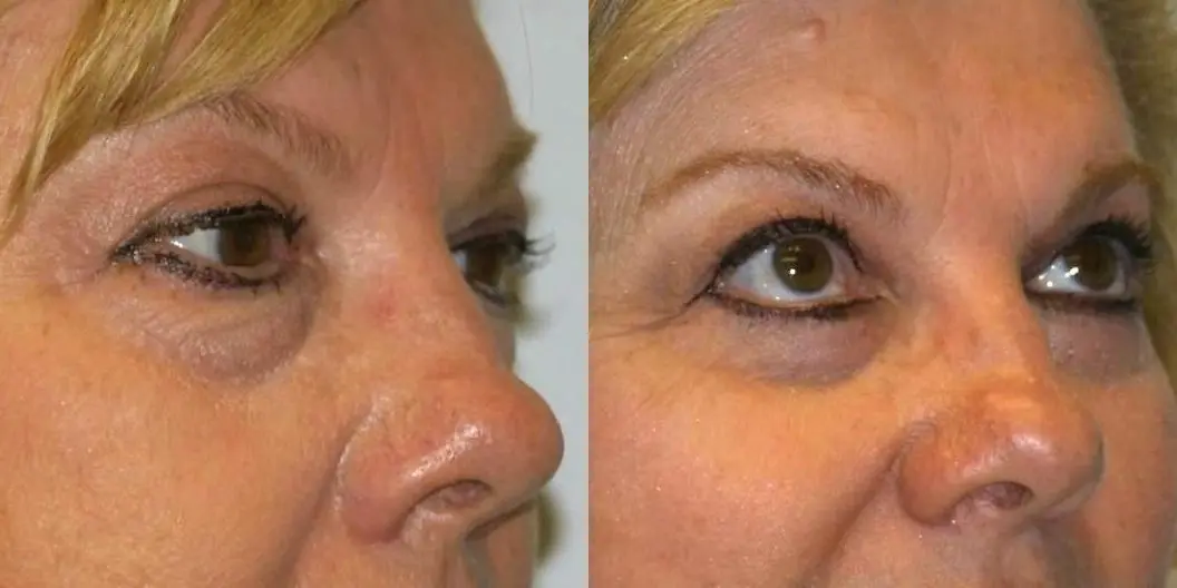 Eyelid Surgery: Patient 7 - Before and After 2