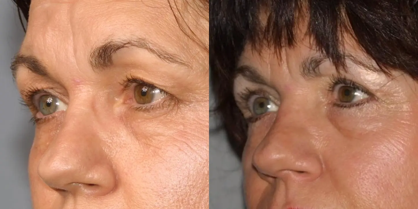 Eyelid Surgery: Patient 5 - Before and After 1