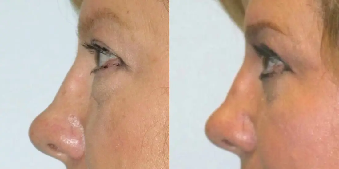 Eyelid Surgery: Patient 7 - Before and After 3