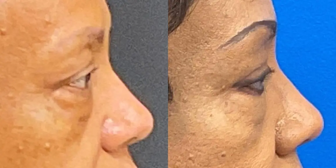 Eyelid Surgery: Patient 3 - Before and After 5