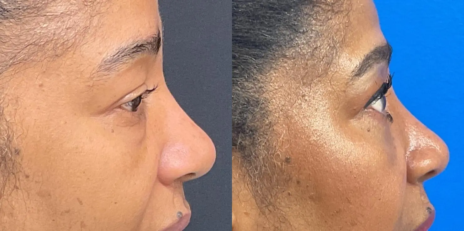 Eyelid Surgery: Patient 1 - Before and After 4