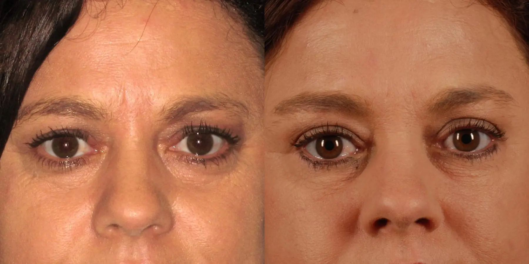 Eyelid Surgery: Patient 6 - Before and After  