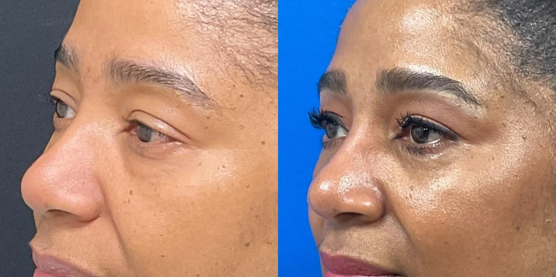 Eyelid Surgery: Patient 1 - Before and After 3