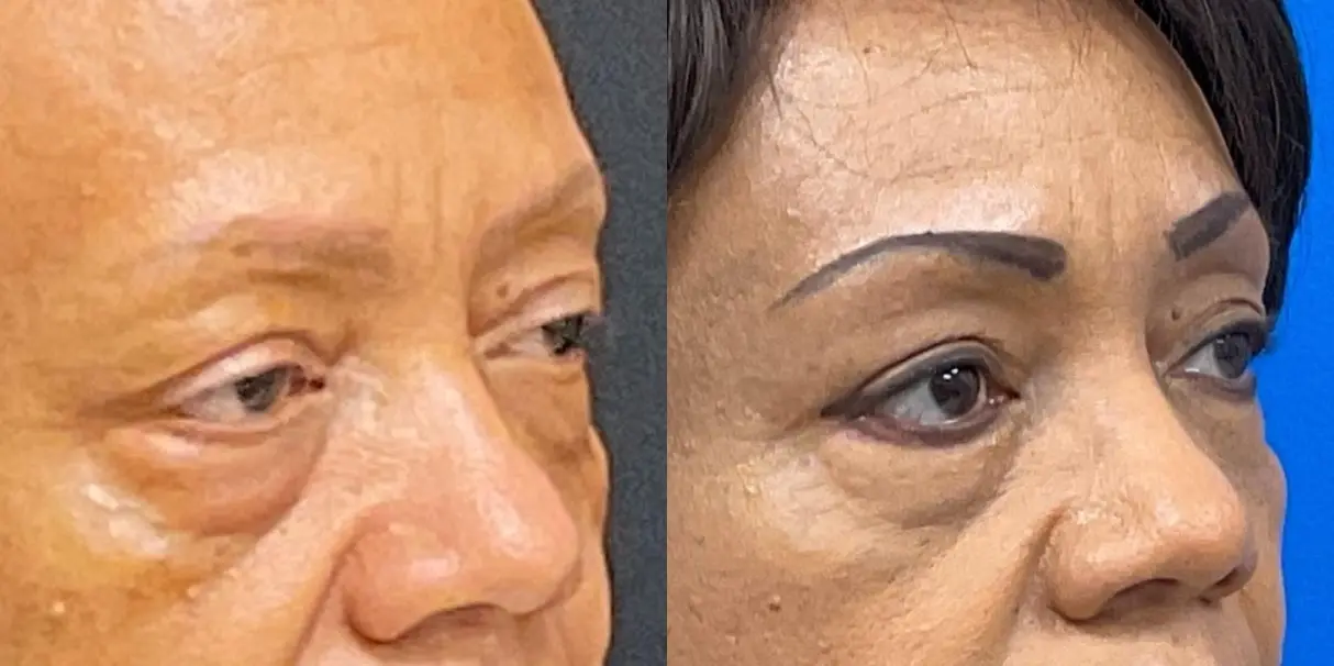 Eyelid Surgery: Patient 3 - Before and After 3