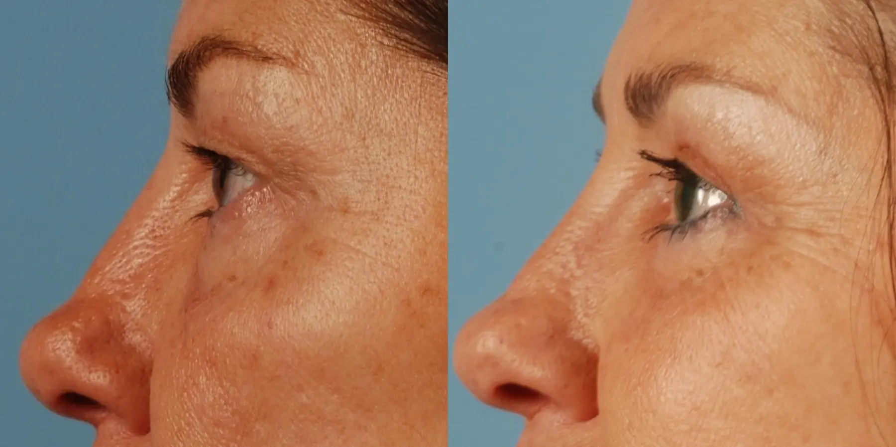 Eyelid Surgery: Patient 4 - Before and After 3