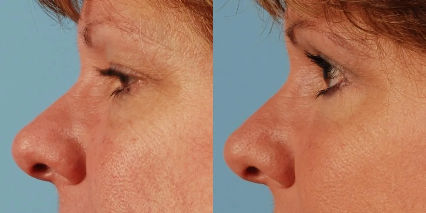 Eyelid Surgery: Patient 9 - Before and After 3