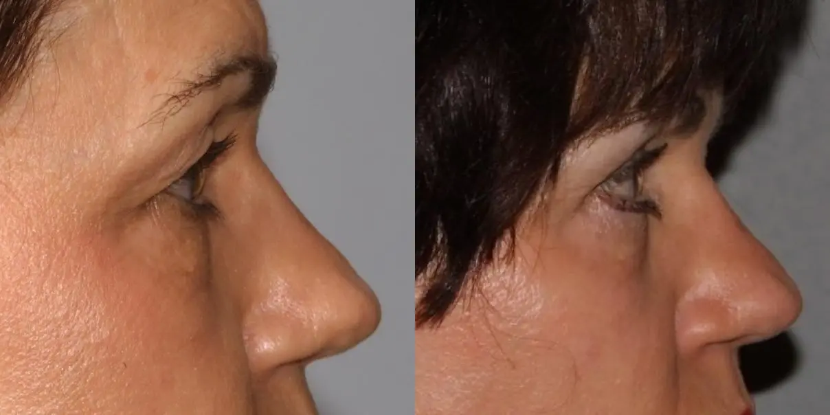 Eyelid Surgery: Patient 5 - Before and After 4