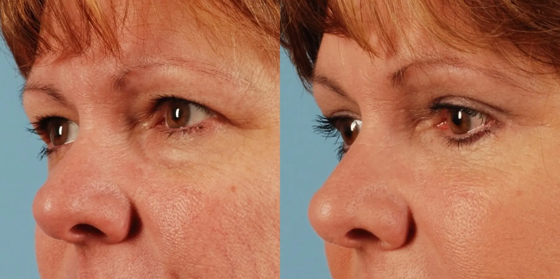 Eyelid Surgery: Patient 9 - Before and After 2