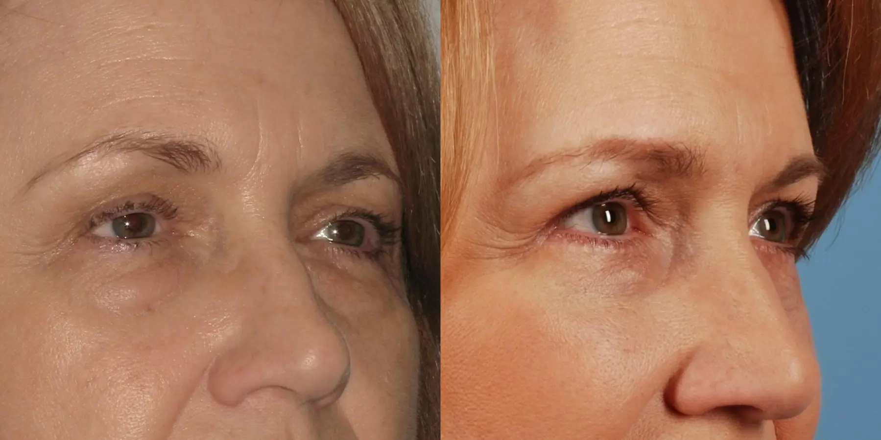 Eyelid Surgery: Patient 8 - Before and After 2