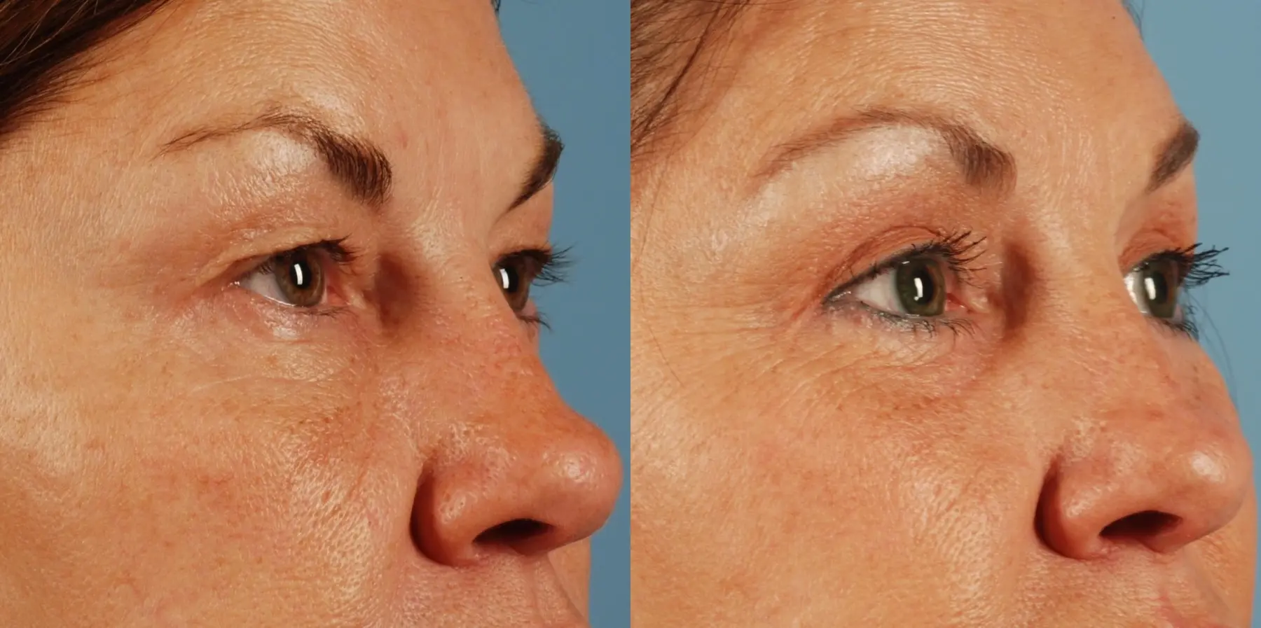 Eyelid Surgery: Patient 4 - Before and After 2