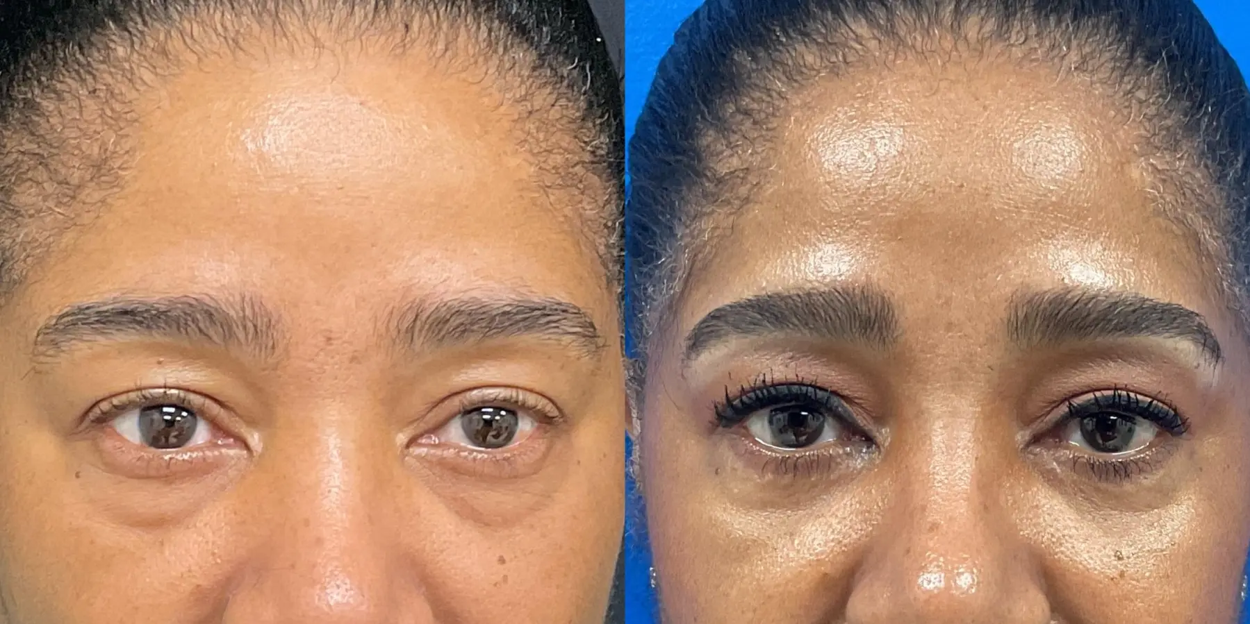 Eyelid Surgery: Patient 1 - Before and After  