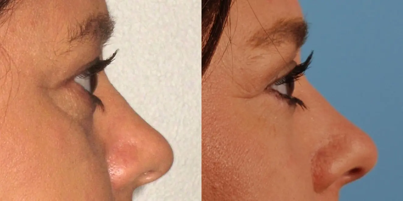 Eyelid Surgery: Patient 6 - Before and After 4