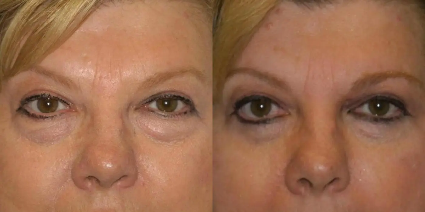 Eyelid Surgery: Patient 7 - Before and After 1