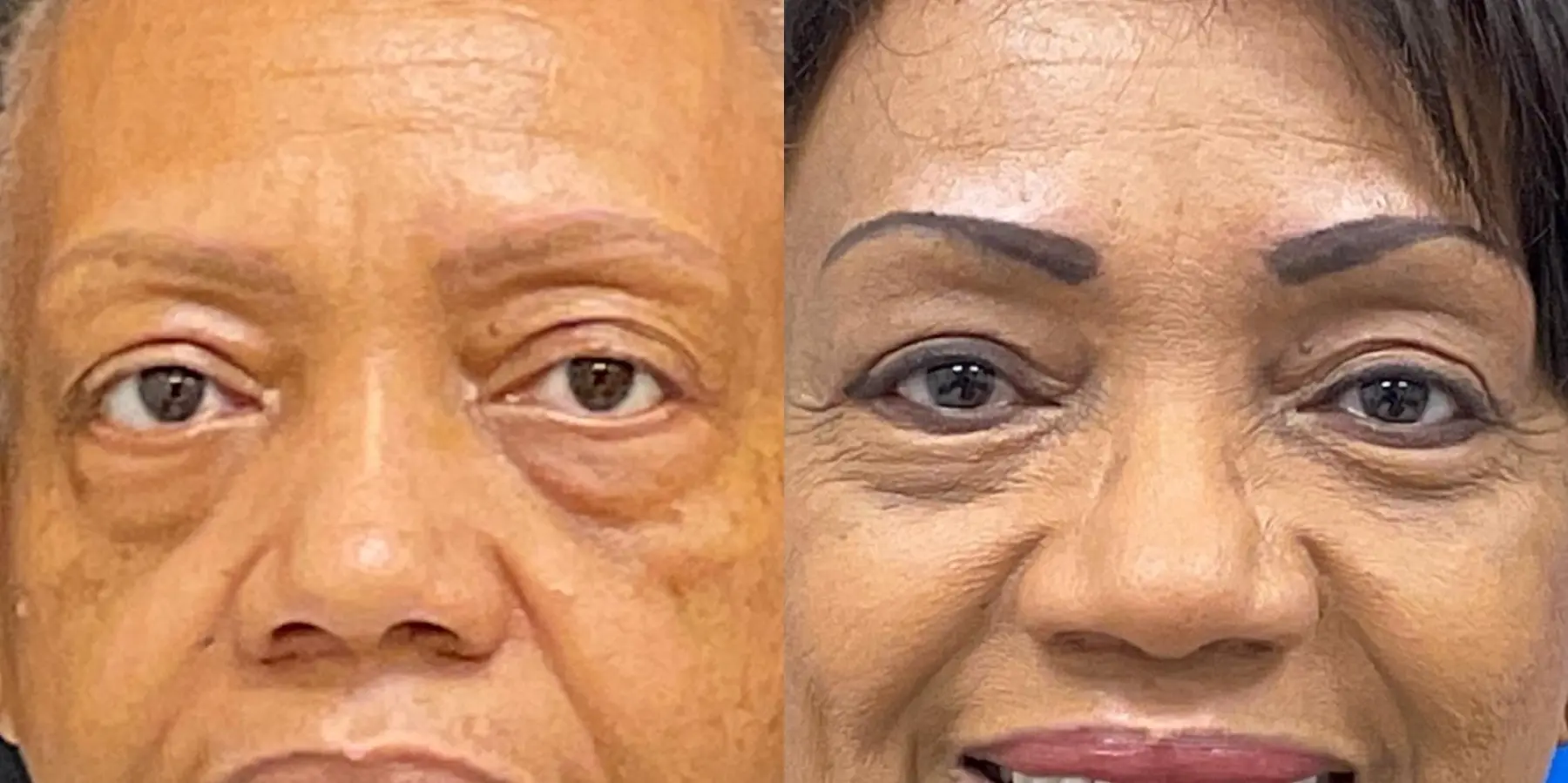 Eyelid Surgery: Patient 3 - Before and After  