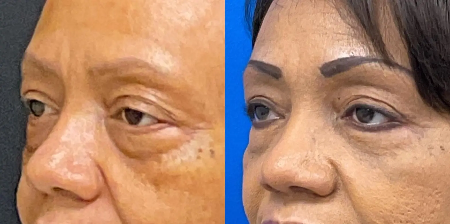 Eyelid Surgery: Patient 3 - Before and After 2