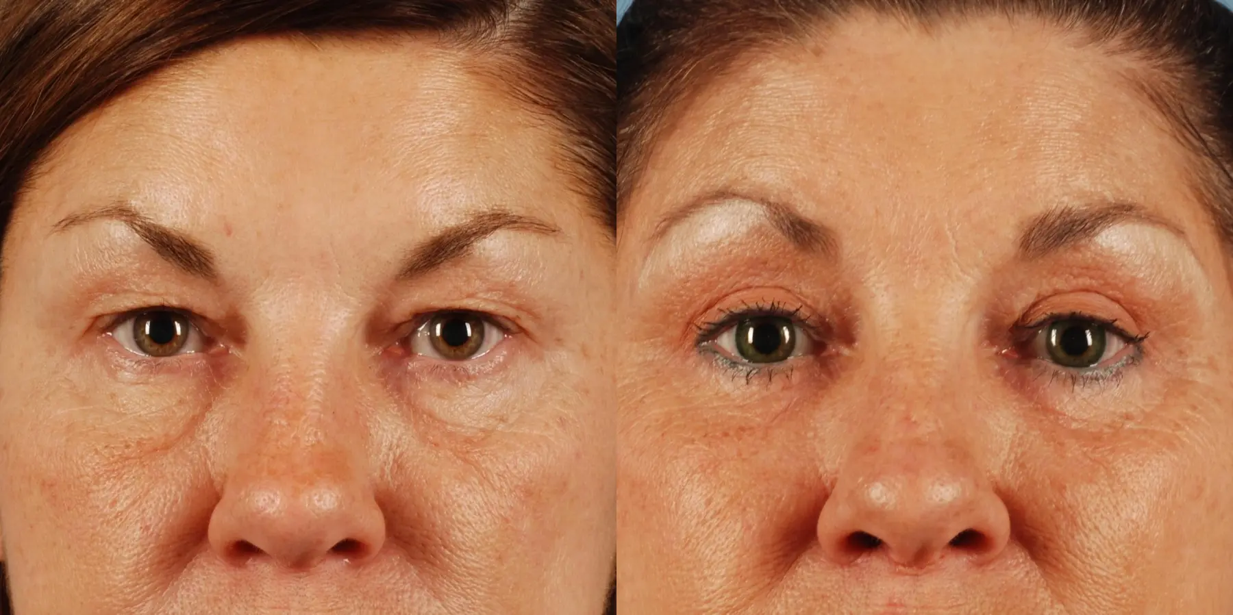 Eyelid Surgery: Patient 4 - Before and After  