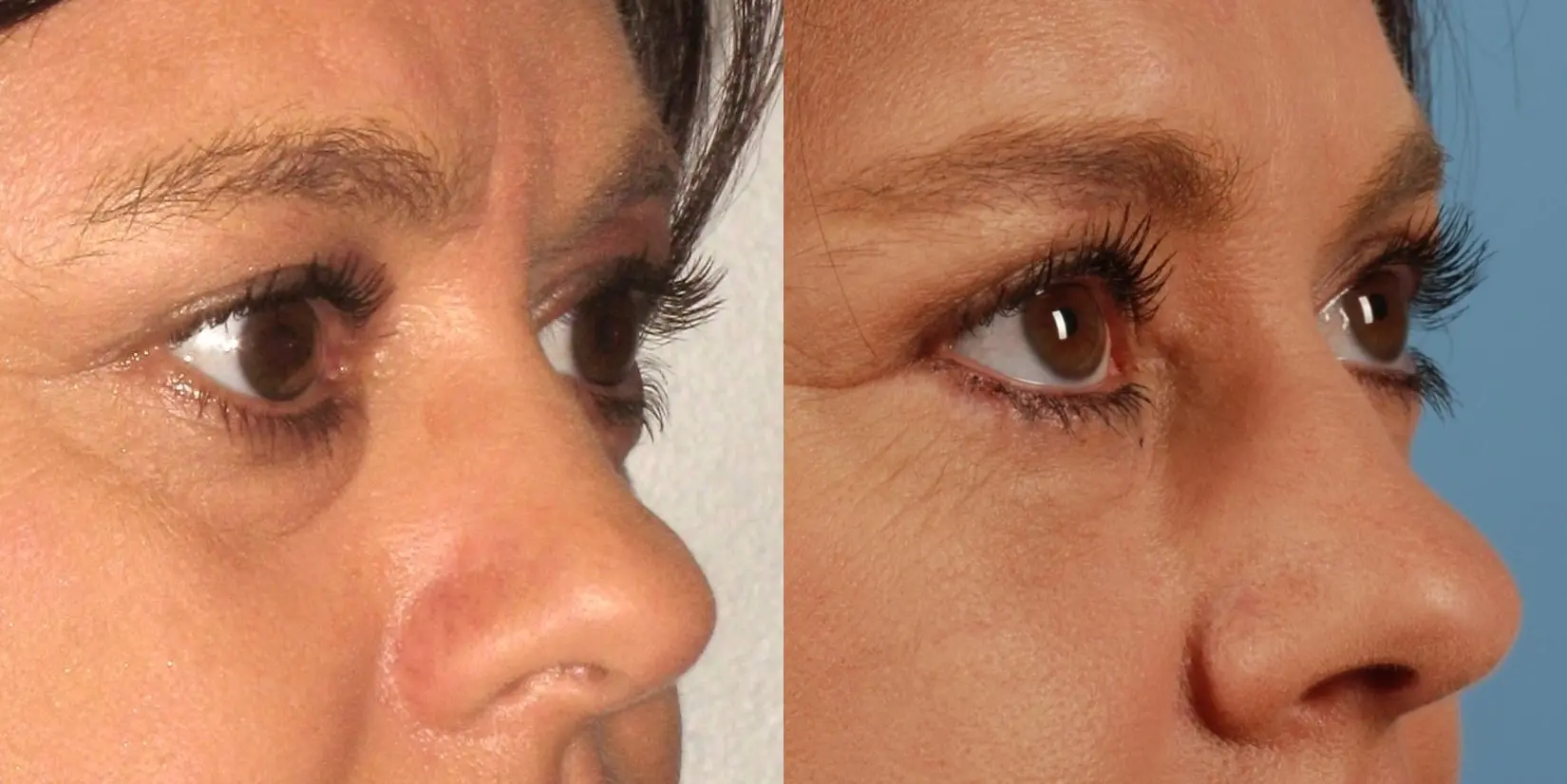 Eyelid Surgery: Patient 6 - Before and After 3