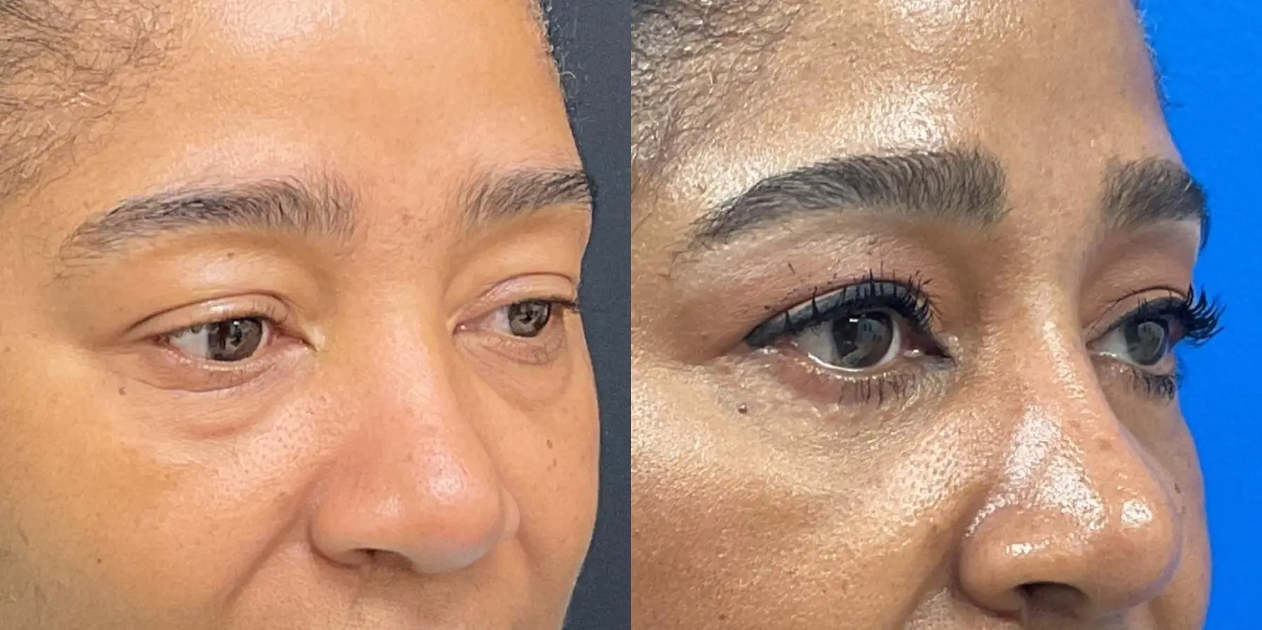 Eyelid Surgery: Patient 1 - Before and After 2