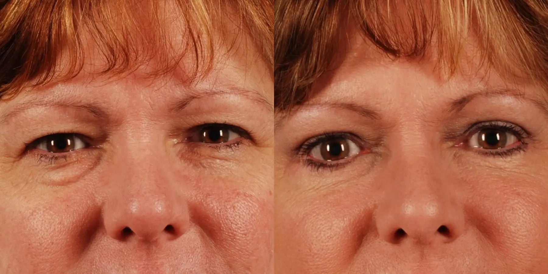 Eyelid Surgery: Patient 9 - Before and After  