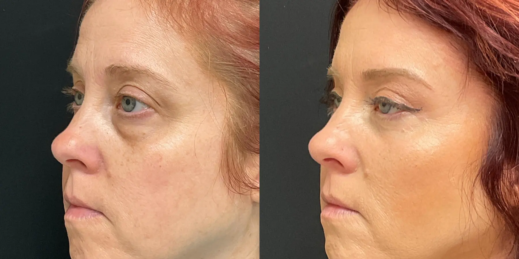 Eyelid Surgery: Patient 2 - Before and After 2