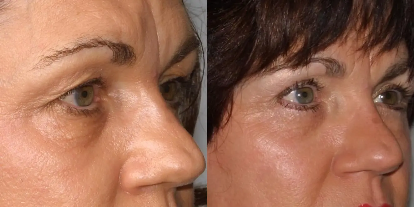 Eyelid Surgery: Patient 5 - Before and After 2