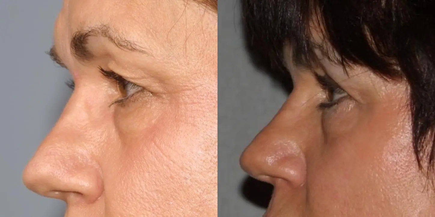 Eyelid Surgery: Patient 5 - Before and After 3