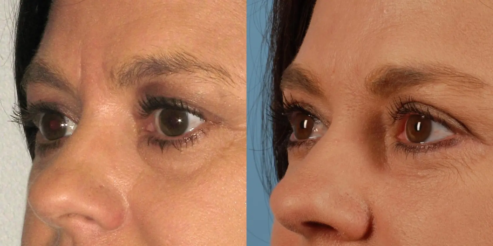 Eyelid Surgery: Patient 6 - Before and After 2