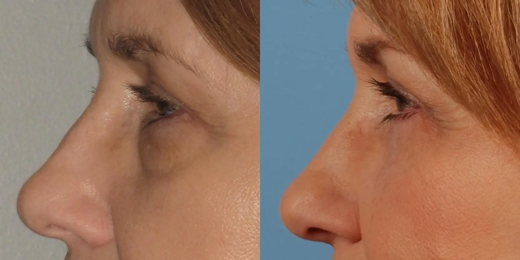 Eyelid Surgery: Patient 8 - Before and After 3