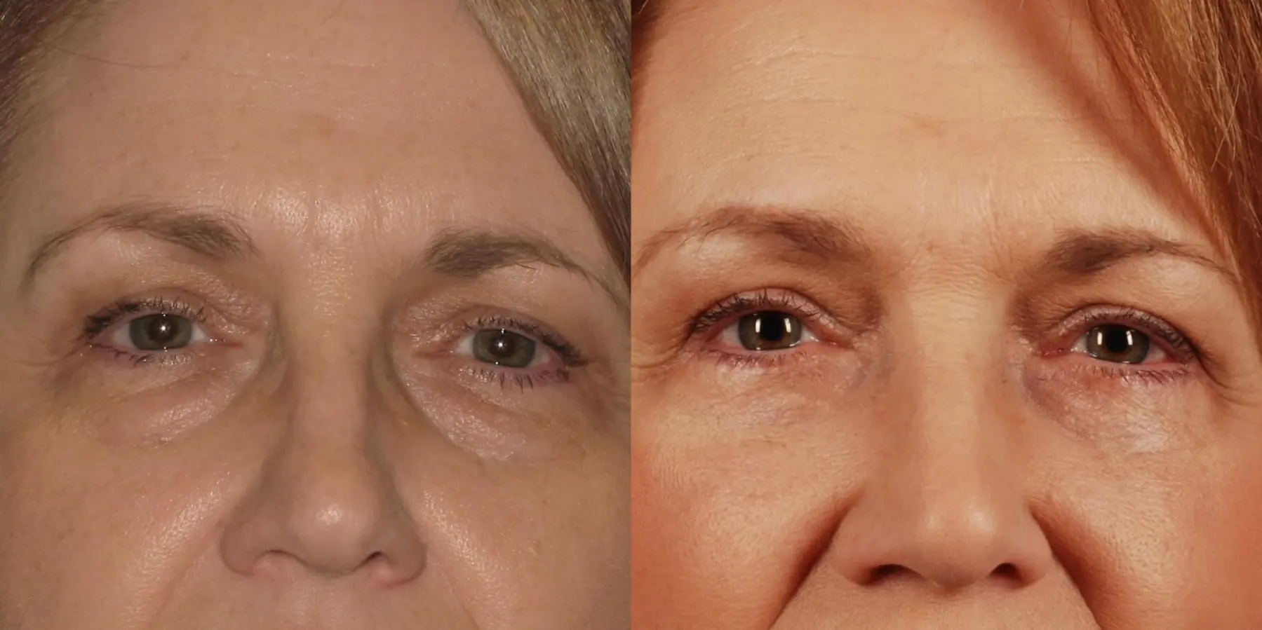 Eyelid Surgery: Patient 8 - Before and After  